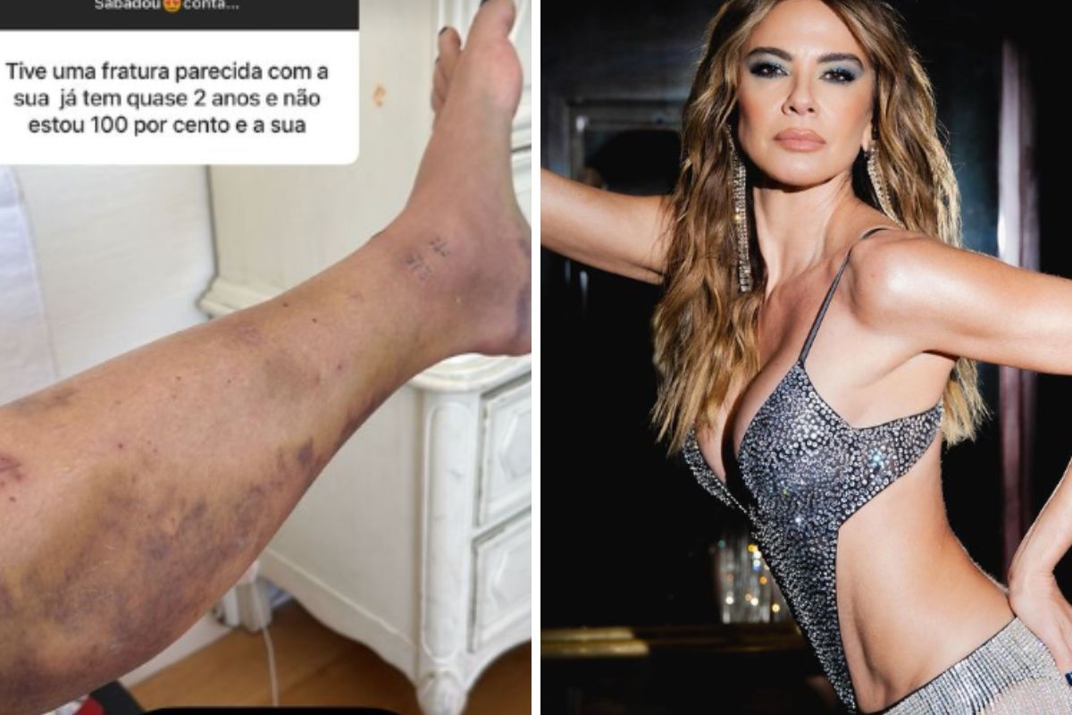 Luciana Gimenez assusta ao mostrar hematomas na perna