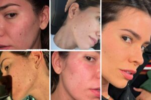 Adriana Sant'Anna com alergia