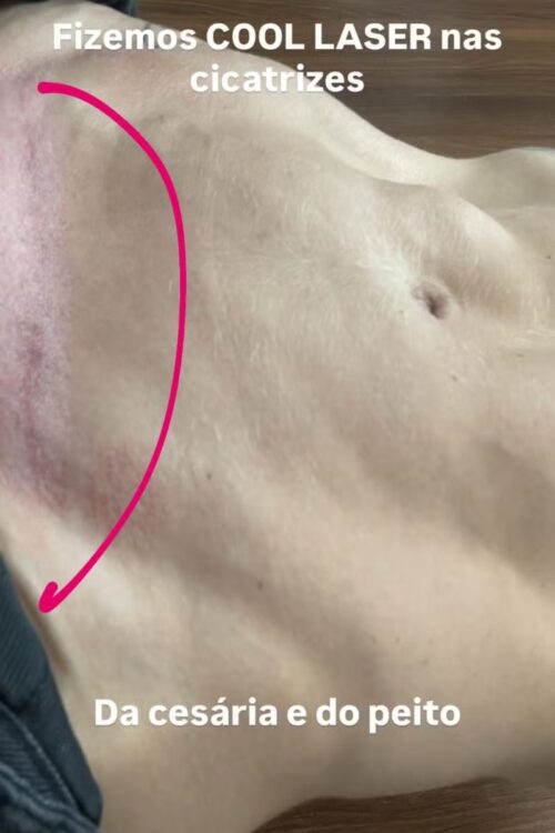 Cicatriz de Virginia