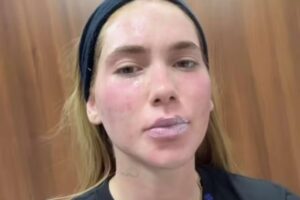 Virginia faz tratamento na pele do rosto