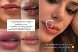 Bruna Biancardi com celulite facial