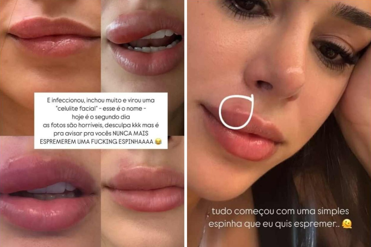 Bruna Biancardi com celulite facial