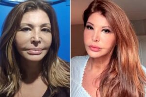 Roberta Close faz harmonização facial