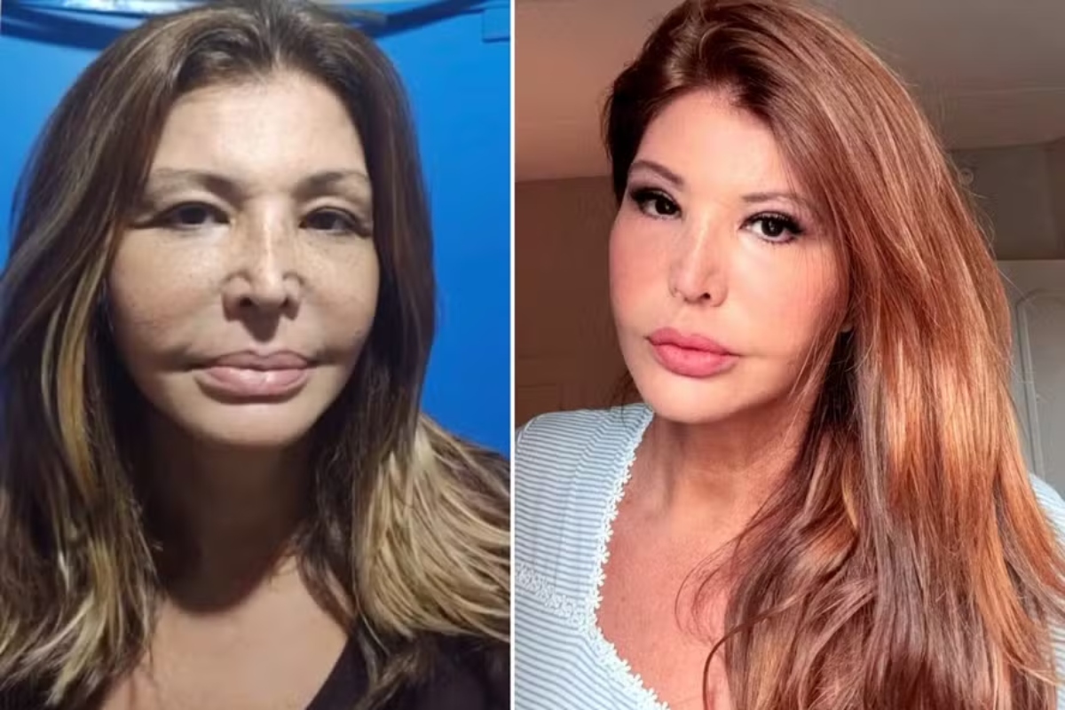 Roberta Close faz harmonização facial