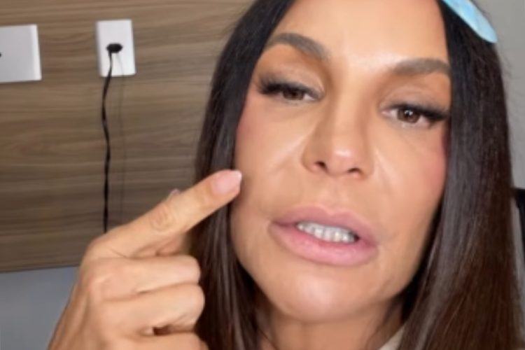 ivete sangalo mostrando rosto após cirurgia