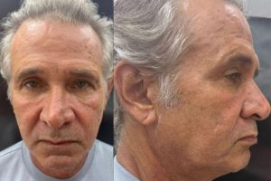 Nelson Freitas faz harmonização facial