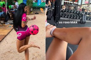 Ana Castela exibe hematomas após jogar futevôlei