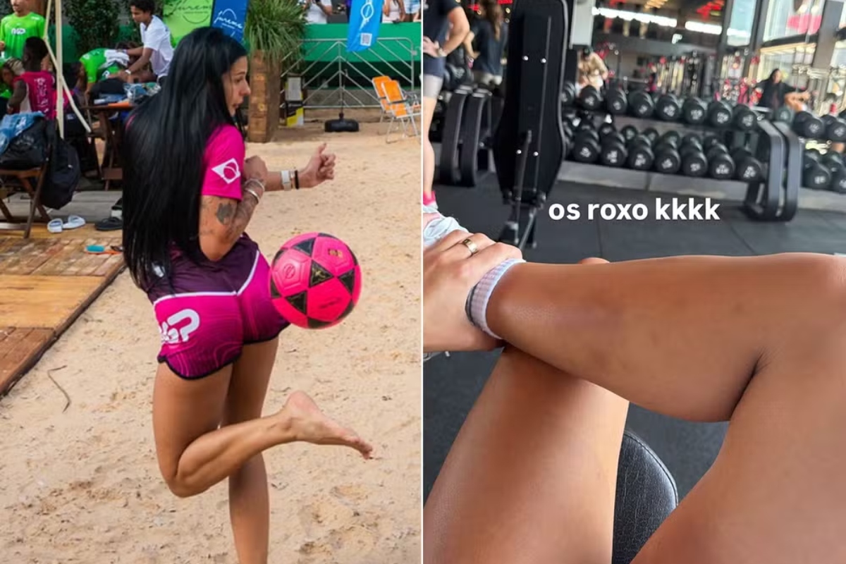 Ana Castela exibe hematomas após jogar futevôlei