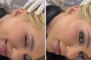 Virginia aplica botox