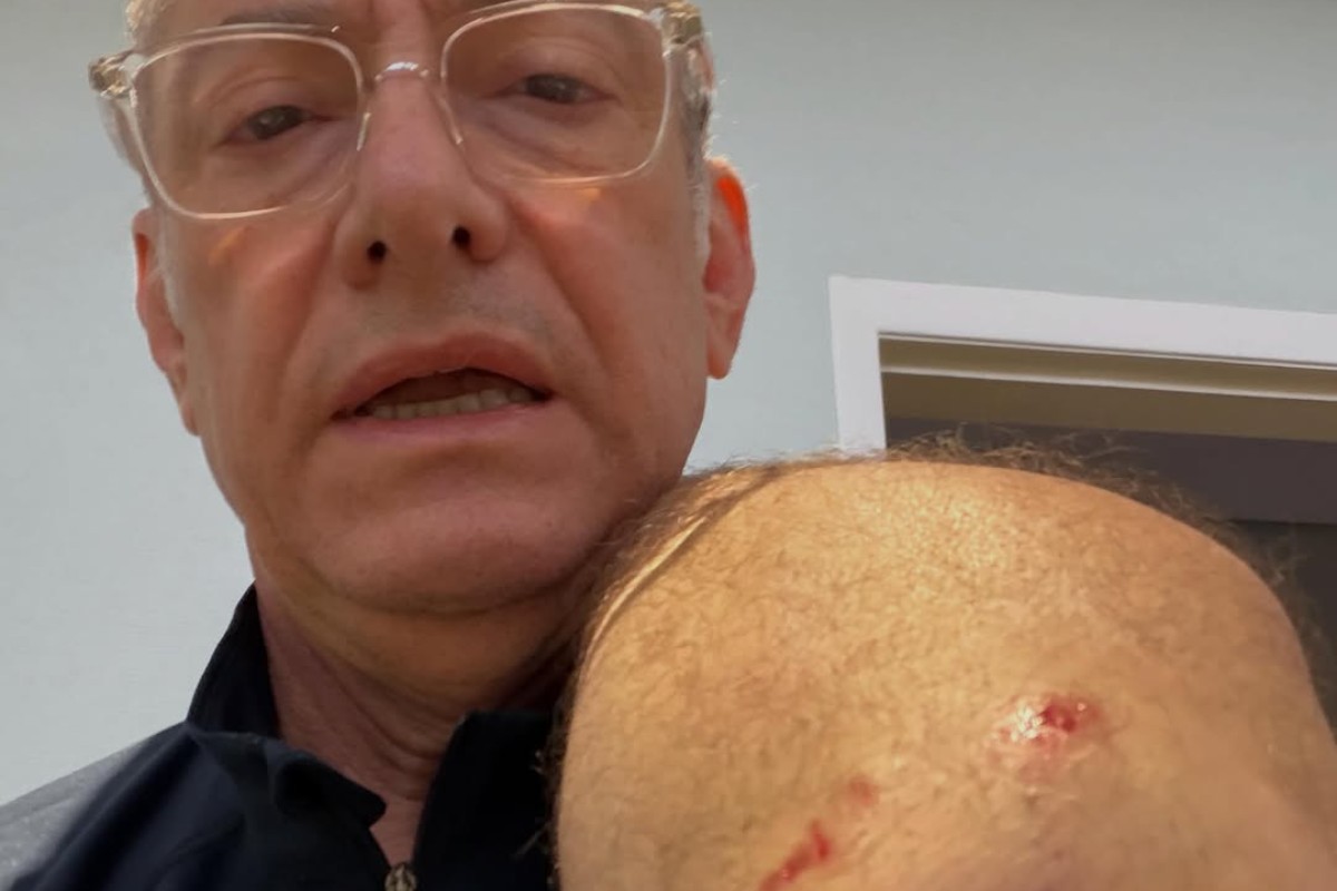 jornalista josé roberto burnier mostrando machucados após ataque de pitbull