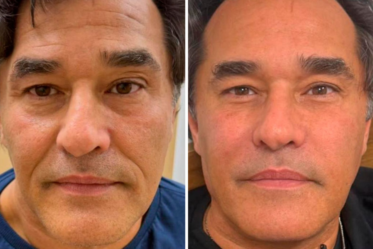 Luciano Szafir exibe resultado da harmonização facial