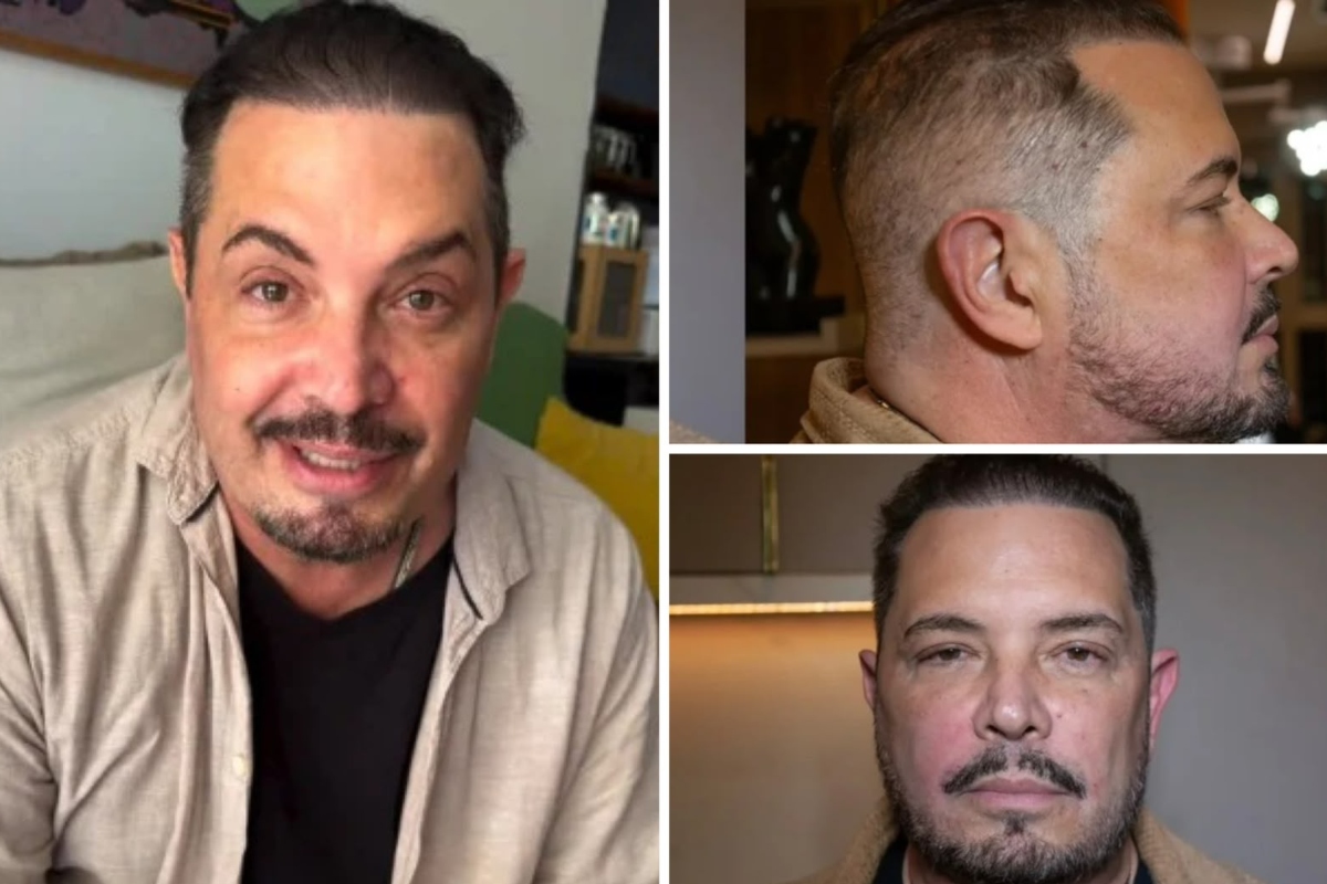 Conrado faz harmonização facial