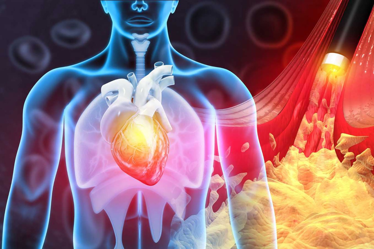 Infarto
