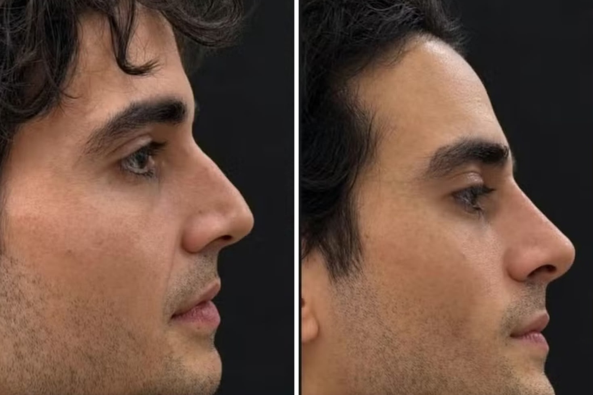 Fiuk faz harmonização facial